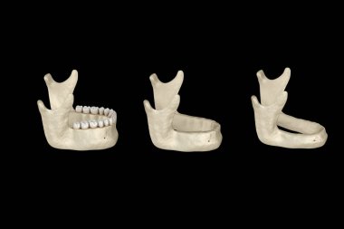Alt çene, dişlerini kaybettikten sonra kemik durgunluğu. Tıbbi olarak doğru olan 3 boyutlu diş illüstrasyonu