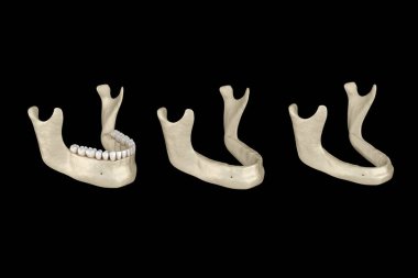 Alt çene, dişlerini kaybettikten sonra kemik durgunluğu. Tıbbi olarak doğru olan 3 boyutlu diş illüstrasyonu