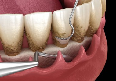 Açık curettage: Ölçekleme ve kök planlama (geleneksel periodontal terapi). İnsan diş tedavisinin tıbbi açıdan doğru üç boyutlu çizimi