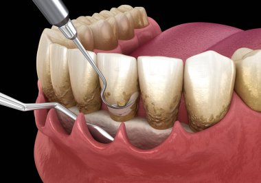 Açık curettage: Ölçekleme ve kök planlama (geleneksel periodontal terapi). İnsan diş tedavisinin tıbbi açıdan doğru üç boyutlu çizimi