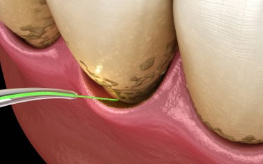 Lazer, enfeksiyon kapmış deri tabakasını ve diş temizliğini ortadan kaldırır. Tıbbi olarak doğru diş 3D illüstrasyon