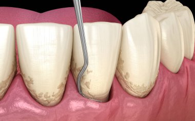 Kapalı kürettage: Ölçekleme ve kök planlama (geleneksel periodontal terapi). İnsan diş tedavisinin tıbbi açıdan doğru üç boyutlu çizimi