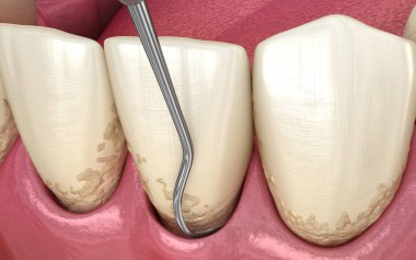 Kapalı kürettage: Ölçekleme ve kök planlama (geleneksel periodontal terapi). İnsan diş tedavisinin tıbbi açıdan doğru üç boyutlu çizimi