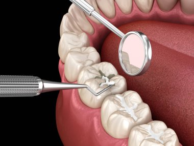 Diş dolgusu ile azı dişi yırtılması. Tıbbi olarak doğru diş 3D illüstrasyon.