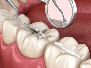Diş dolgusu ile azı dişi yırtılması. Tıbbi olarak doğru diş 3D illüstrasyon.