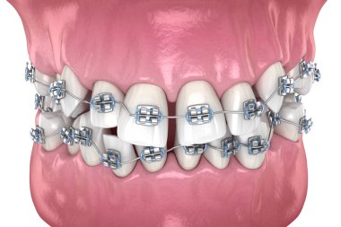 Anormal diş pozisyonu ve metal diş telleriyle düzeltme. Tıbbi olarak doğru olan 3 boyutlu diş illüstrasyonu
