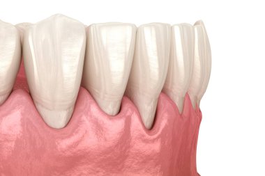 Gum recession process. Medically accurate 3D illustration clipart