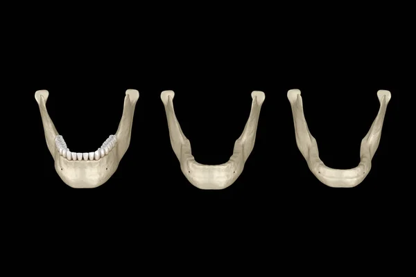 Mandíbula Recessão Óssea Depois Perder Dentes Ilustração Odontológica Medicamente Precisa — Fotografia de Stock