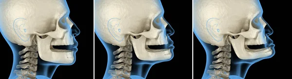 Мендібулярна Щелепа Спад Кісток Після Втрати Зубів Методично Точний Приклад — стокове фото