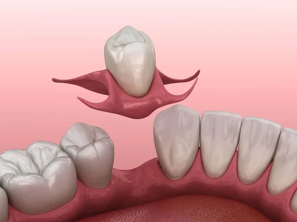 Dentadura Parcial Extraíble Tipo Inmediato Mariposa Sustitución Diente Faltante Ilustración —  Fotos de Stock