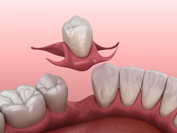 Partial removable immediate-denture type Butterfly. Replacement of one missing tooth 3D illustration