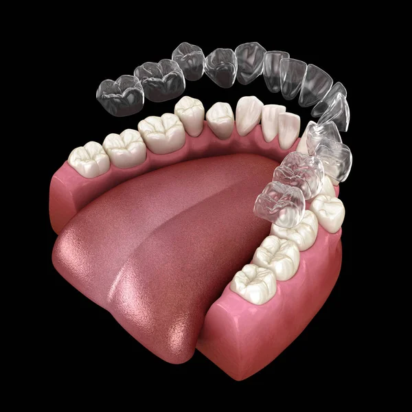 Los Aparatos Ortopédicos Invisalign Retenedor Invisible Hacen Corrección Mordida Ilustración —  Fotos de Stock