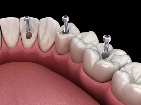 Zahnbrücke Auf Basis Von Implantaten Medizinisch Genaue Abbildung Des Konzepts — Stockfoto