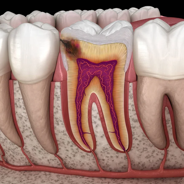 モルの歯に隠されたキャリー 医学的に正確な3Dイラスト — ストック写真