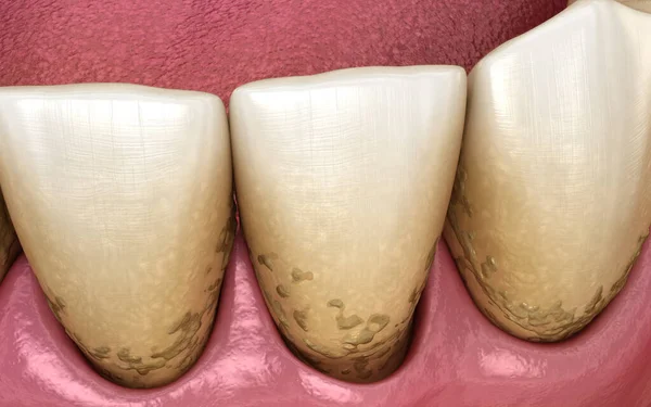 Zahnbelag Mit Zahnstein Und Speck Unterkiefer Medizinisch Genaue Abbildung Der — Stockfoto
