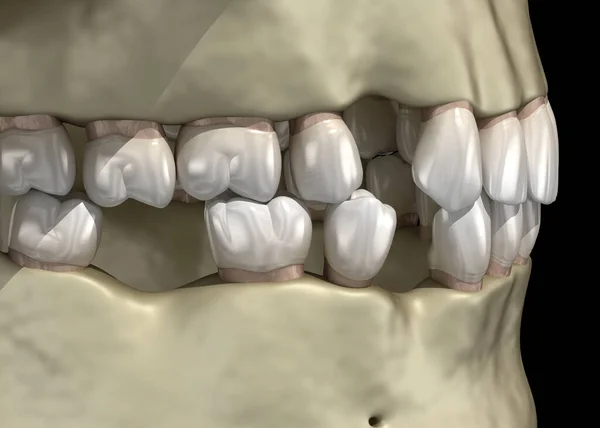 Μετακίνηση Δοντιών Παραμορφωτικό Μετά Την Απώλεια Δοντιών Απεικόνιση Του Φαινομένου — Φωτογραφία Αρχείου