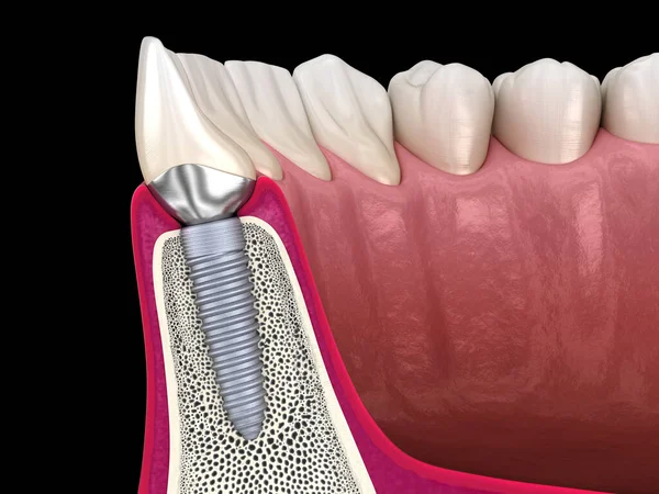 Maßgeschneiderter Aufbau Zahnimplantat Und Keramikkrone Medizinisch Korrekte Darstellung Der Zähne — Stockfoto