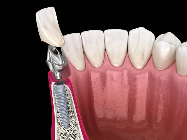 Custom abutment, dental implant and ceramic crown. Medically accurate tooth 3D illustration.