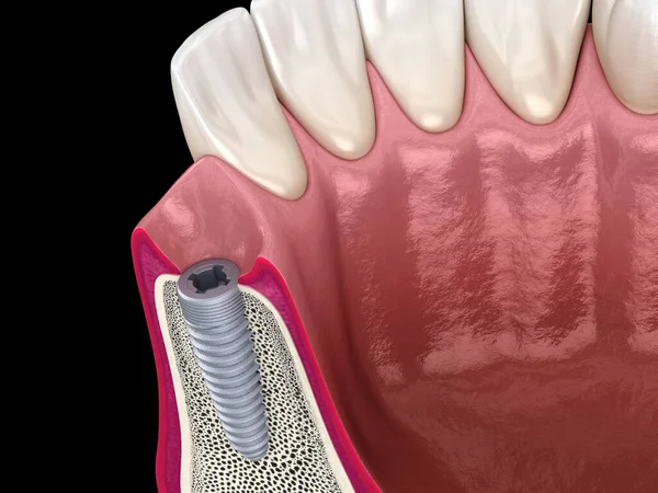 Installierte Zahnimplantate Medizinisch Korrekte Darstellung Der Zähne — Stockfoto