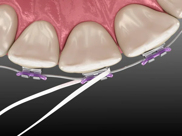 Processo Limpeza Aparelho Dental Fio Dental Ilustração Medicamente Precisa Higiene — Fotografia de Stock