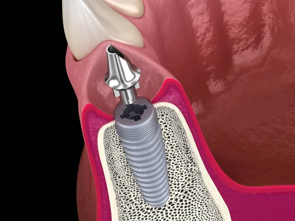 标准基托 假牙植入物和陶瓷冠 医学上准确的牙齿3D图像 — 图库照片