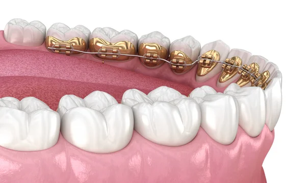 Healthy Teeth with gold braces, white teeth concept, dental 3D illustration