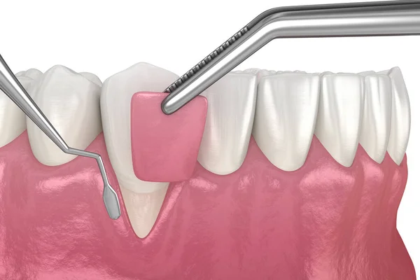 Gum Ύφεση Μαλακό Μόσχευμα Ιστού Χειρουργική Επέμβαση Απεικόνιση Της Οδοντιατρικής — Φωτογραφία Αρχείου