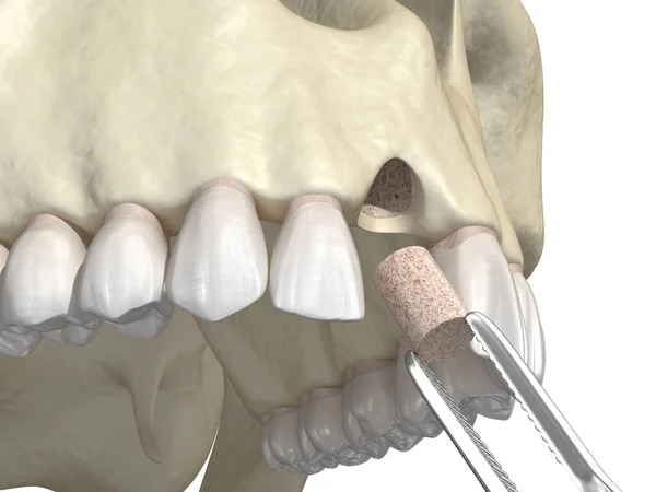 Innesto Osseo Aumento Con Metodo Anello Impianto Dentale Illustrazione Clinicamente — Foto Stock