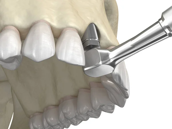 Przeszczepienie Kości Powiększenie Metodą Pierścienia Wszczepienie Zęba Medycznie Dokładna Ilustracja — Zdjęcie stockowe