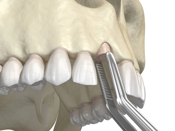 Przeszczepienie Kości Powiększenie Metodą Pierścienia Wszczepienie Zęba Medycznie Dokładna Ilustracja — Zdjęcie stockowe