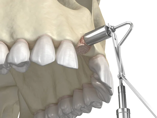 Aumento Enxertia Óssea Usando Método Anel Implante Dentário Ilustração Medicamente — Fotografia de Stock