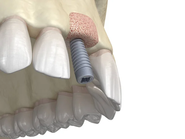 Greffe Osseuse Augmentation Par Méthode Anneau Implantation Dentaire Illustration Médicalement — Photo