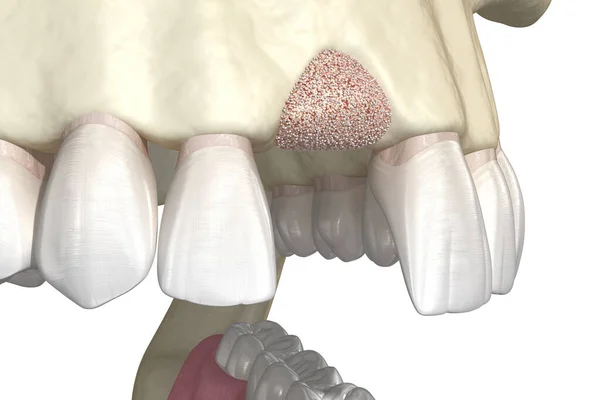 Cirurgia Aumento Adicionando Osso Após Extração Dentária Ilustração — Fotografia de Stock