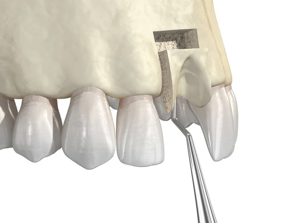 Aumento Enxertia Óssea Usando Bloco Osso Implante Dentário Ilustração Medicamente — Fotografia de Stock