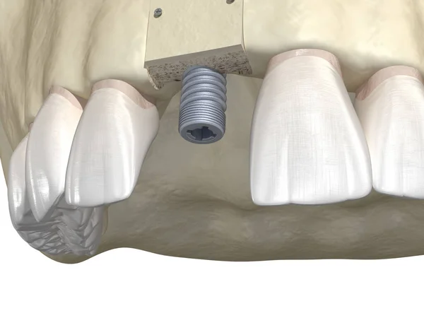 Greffe Osseuse Augmentation Par Bloc Osseux Implantation Dentaire Illustration Médicalement — Photo