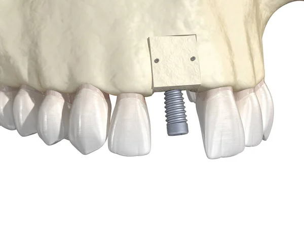 Підсилення Кісткової Щеплення Використанням Блоку Кістки Імплантації Зубів Медично Точна — стокове фото