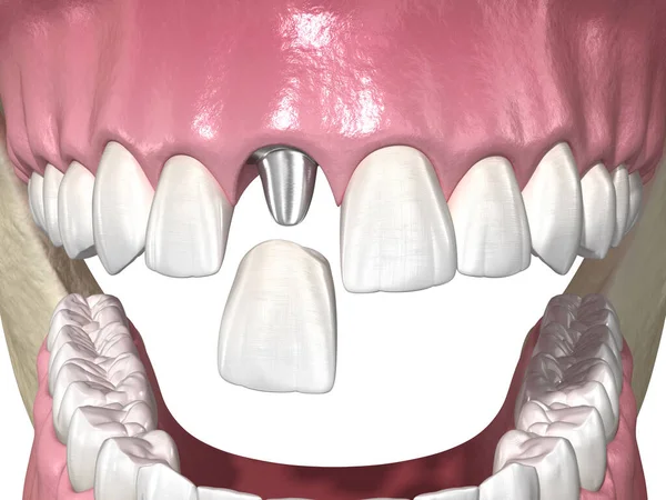 Okolica Celna Implant Stomatologiczny Korona Ceramiczna Medycznie Dokładna Ilustracja Zęba — Zdjęcie stockowe