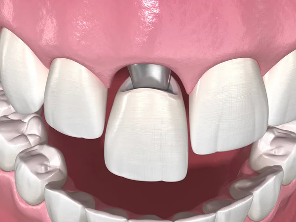 Abutment Personalizzato Impianto Dentale Corona Ceramica Illustrazione Del Dente Clinicamente — Foto Stock