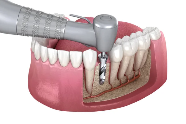 Vrtání Kostí Při Umístění Zubního Implantátu Lékařsky Přesná Ilustrace Konceptu — Stock fotografie