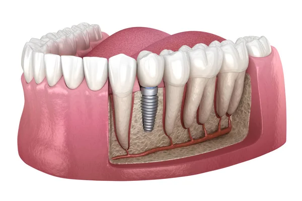 Premolární Instalace Zubní Koruny Nad Implantátem Lékařsky Přesná Ilustrace Konceptu — Stock fotografie