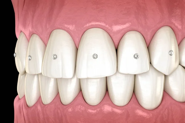 Dekoracja Zębów Biżuterią Koncepcja Ilustracji — Zdjęcie stockowe