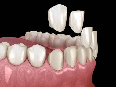Merkezi kesici diş ve yan kesici dişler üzerinde vener kurulum prosedürü. Tıbbi olarak doğru diş 3D illüstrasyon