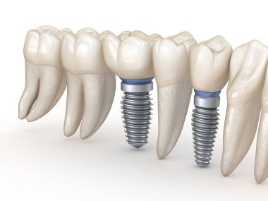 Diş implantları devrede. İnsan dişlerinin 3 boyutlu illüstrasyon kavramı.