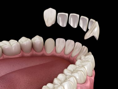 Merkezi kesici diş ve yan kesici dişler üzerinde vener kurulum prosedürü. Tıbbi olarak doğru diş 3D illüstrasyon