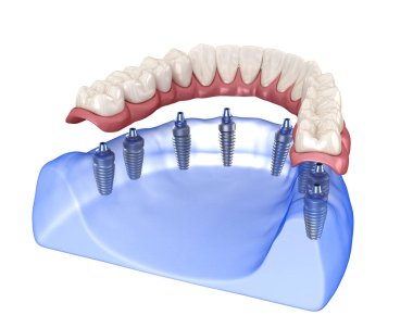 Çikletli Maxillary ve Mandibular protez. Hepsi de implantlarla desteklenen 8 sistemde. İnsan dişlerinin ve protezlerinin tıbbi açıdan doğru üç boyutlu çizimi