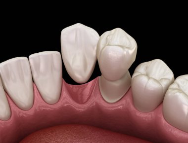 Cantilever Köprüsü, seramik ve ön dişlerden yapılmış. Diş konseptinin tıbben doğru 3 boyutlu animasyonu