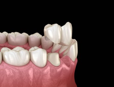 Cantilever Köprüsü, seramik ve ön dişlerden yapılmış. Diş konseptinin tıbben doğru 3 boyutlu animasyonu