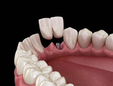 Cantilever Köprüsü implantı, ön diş tedavisi. Diş konseptinin tıbben doğru 3 boyutlu animasyonu