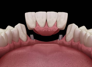 Ön diş köprüsü implantlarla destekleniyor. Diş konseptinin tıbben doğru 3D animasyonu
