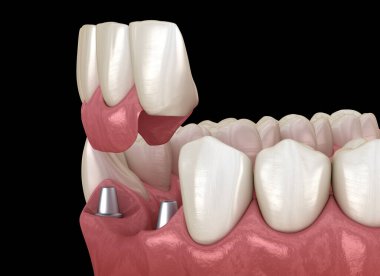 Ön diş köprüsü implantlarla destekleniyor. Diş konseptinin tıbben doğru 3D animasyonu